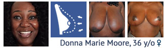 Breast Reduction patient at cosmetic surgery partners London