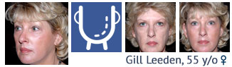 facelift patient at cosmetic surgery partners London