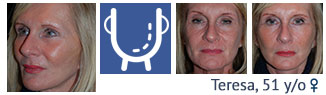 facelift patient at cosmetic surgery partners London