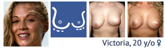 Breast Augmentation patient case study