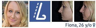 Rhinoplasty patient case study