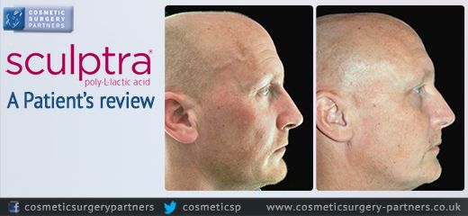 Sculptra facial treatment for men