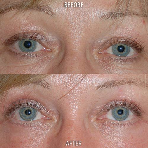 blepharoplasty surgery before and after patient results front view photo at Cosmetic Surgery Partners London