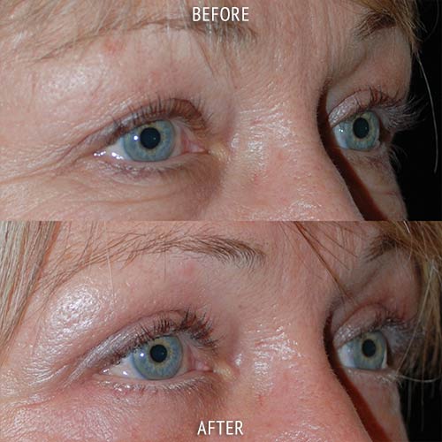 blepharoplasty surgery before and after patient results oblique angle view photo at Cosmetic Surgery Partners London