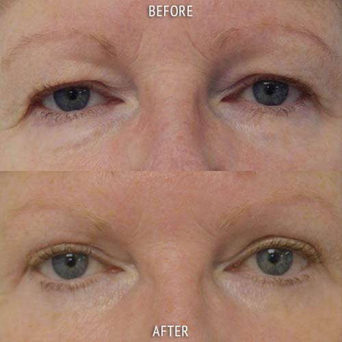 blepharoplasty surgery before and after patient results front view photo at Cosmetic Surgery Partners London