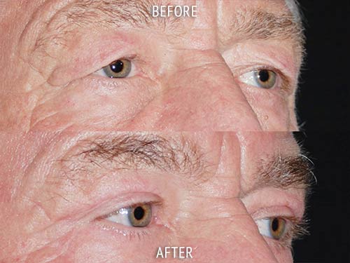 blepharoplasty surgery before and after patient results oblique angle view photo at Cosmetic Surgery Partners London
