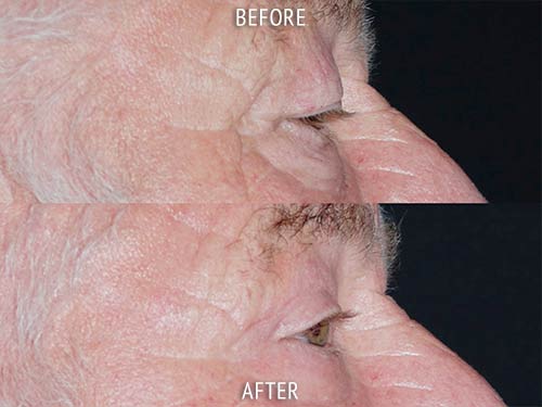 blepharoplasty surgery before and after patient results side view photo at Cosmetic Surgery Partners London