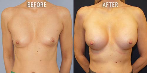 breast augmentation surgery before and after patient results front view photo at Cosmetic Surgery Partners London