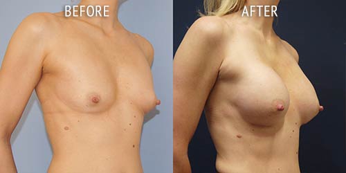 breast augmentation surgery before and after patient results oblique angle view photo at Cosmetic Surgery Partners London