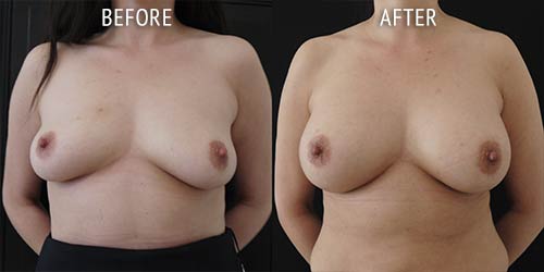 breast augmentation surgery before and after patient results front view photo at Cosmetic Surgery Partners London