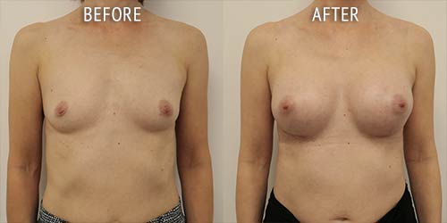 breast augmentation surgery before and after patient results front view photo at Cosmetic Surgery Partners London