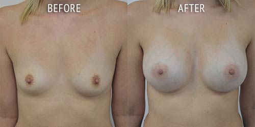 breast augmentation surgery before and after patient results front view photo at Cosmetic Surgery Partners London