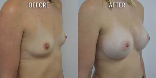 breast augmentation surgery before and after patient results oblique angle view photo at Cosmetic Surgery Partners London