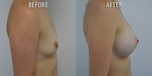 breast augmentation surgery before and after patient results side view photo at Cosmetic Surgery Partners London