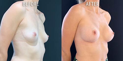 breast augmentation surgery before and after patient results oblique angle view photo at Cosmetic Surgery Partners London