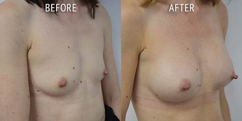 breast augmentation surgery before and after patient results oblique angle view photo at Cosmetic Surgery Partners London