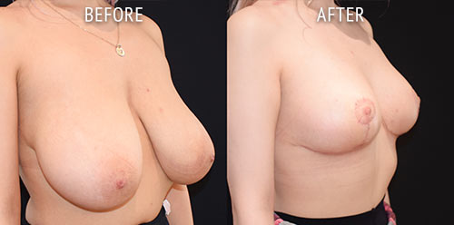 breast reduction surgery before and after patient results oblique angle view photo at Cosmetic Surgery Partners London