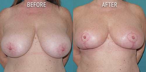 breast reduction surgery before and after patient results front view photo at Cosmetic Surgery Partners London
