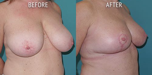 breast reduction surgery before and after patient results oblique angle view photo at Cosmetic Surgery Partners London