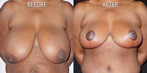 breast reduction surgery before and after patient results front view photo at Cosmetic Surgery Partners London