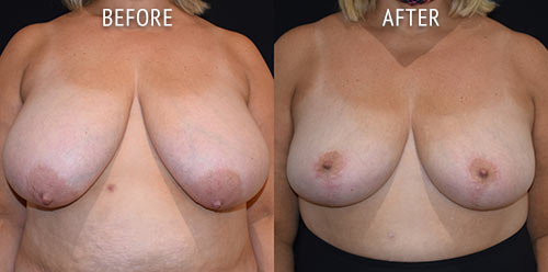breast reduction surgery before and after patient results front view photo at Cosmetic Surgery Partners London