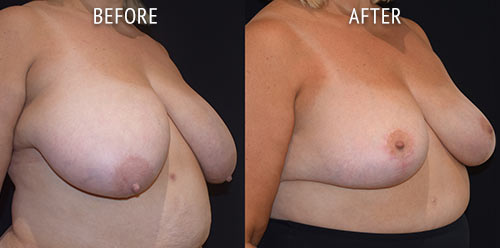 breast reduction surgery before and after patient results oblique angle view photo at Cosmetic Surgery Partners London
