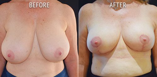breast reduction surgery before and after patient results front view photo at Cosmetic Surgery Partners London
