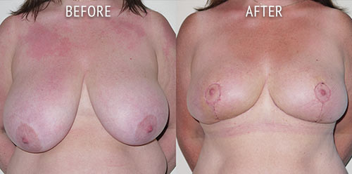 breast reduction surgery before and after patient results front view photo at Cosmetic Surgery Partners London