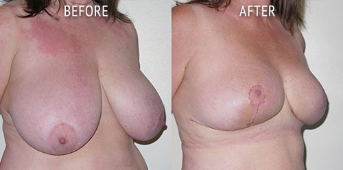 breast reduction surgery before and after patient results oblique angle view photo at Cosmetic Surgery Partners London