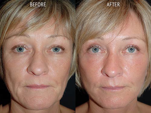 face lift surgery before and after patient results front view photo at Cosmetic Surgery Partners London