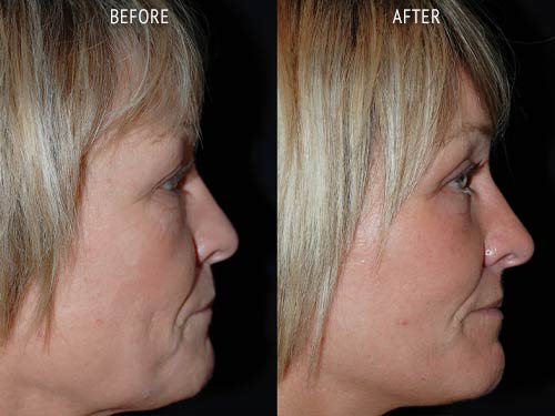 face lift surgery before and after patient results side view photo at Cosmetic Surgery Partners London