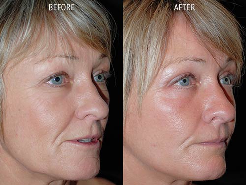face lift surgery before and after patient results oblique angle view photo at Cosmetic Surgery Partners London