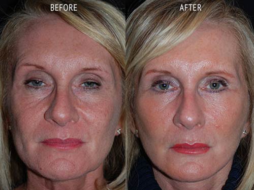 face lift surgery before and after patient results front view photo at Cosmetic Surgery Partners London
