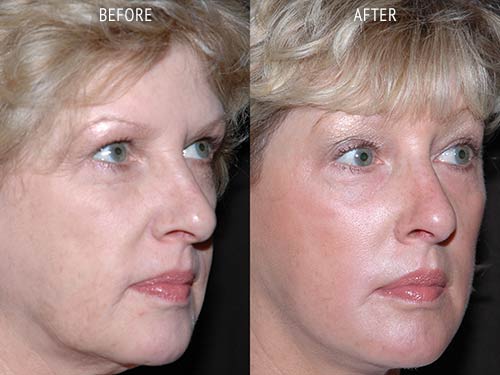 face lift surgery before and after patient results oblique angle view photo at Cosmetic Surgery Partners London