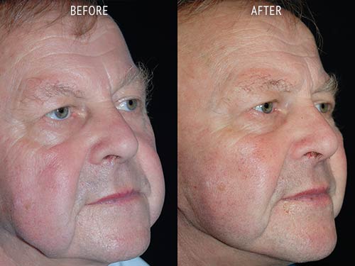 face lift surgery before and after patient results oblique angle view photo at Cosmetic Surgery Partners London