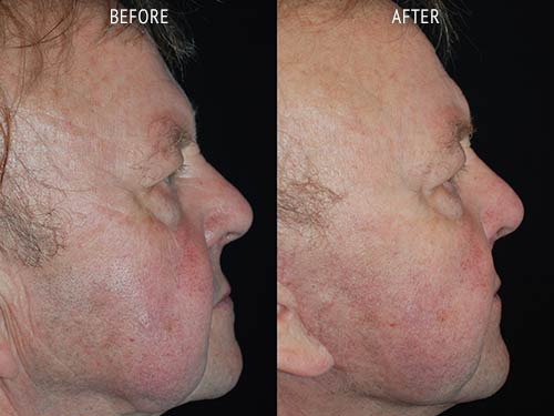 face lift surgery before and after patient results side view photo at Cosmetic Surgery Partners London
