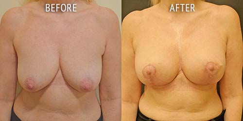 breast uplift surgery before and after patient results front view photo at Cosmetic Surgery Partners London