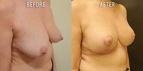 breast uplift surgery before and after patient results oblique angle view photo at Cosmetic Surgery Partners London