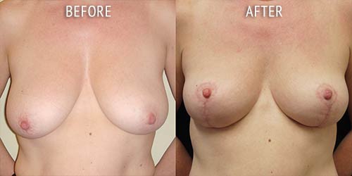 breast uplift surgery before and after patient results front view photo at Cosmetic Surgery Partners London