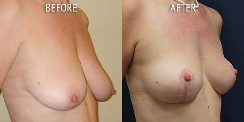 breast uplift surgery before and after patient results oblique angle view photo at Cosmetic Surgery Partners London