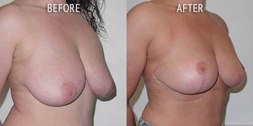 breast uplift surgery before and after patient results oblique angle view photo at Cosmetic Surgery Partners London