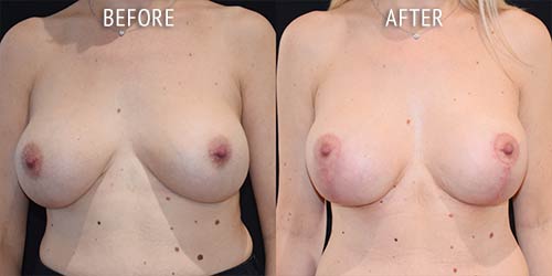 breast uplift surgery before and after patient results front view photo at Cosmetic Surgery Partners London