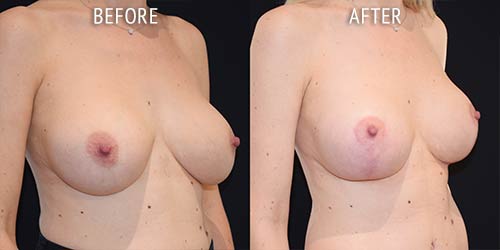 breast uplift surgery before and after patient results oblique angle view photo at Cosmetic Surgery Partners London