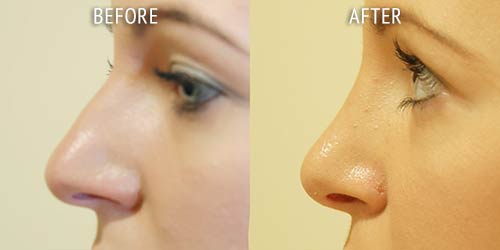 rhinoplasty surgery before and after patient results side view photo at Cosmetic Surgery Partners London