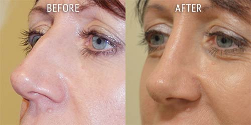rhinoplasty surgery before and after patient results oblique angle view photo at Cosmetic Surgery Partners London