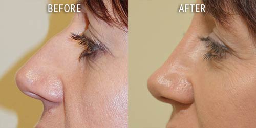 rhinoplasty surgery before and after patient results side view photo at Cosmetic Surgery Partners London