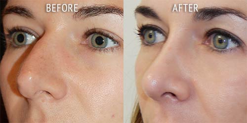 rhinoplasty surgery before and after patient results oblique angle view photo at Cosmetic Surgery Partners London
