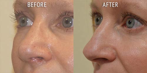 rhinoplasty surgery before and after patient results oblique angle view photo at Cosmetic Surgery Partners London