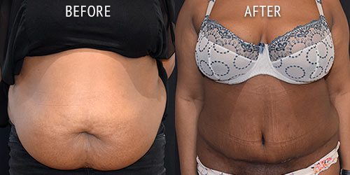 abdominoplasty surgery before and after patient results front view photo at Cosmetic Surgery Partners London