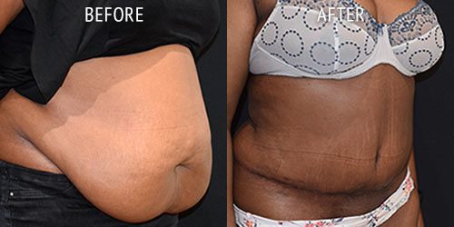 abdominoplasty surgery before and after patient results oblique angle view photo at Cosmetic Surgery Partners London